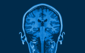 Imaging scan of person's head and brain from rear view.