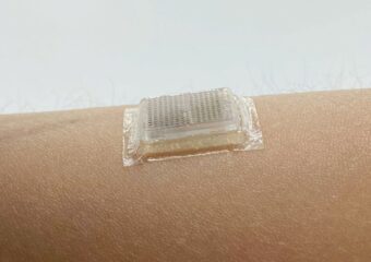 A bioadhesive ultrasound device adhered to the skin