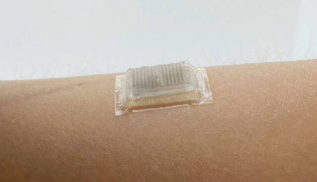 A bioadhesive ultrasound device adhered to the skin